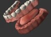 Full Arch Dentures
