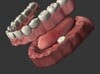 Over Denture