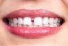 Orthodontic Closing Gaps