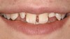 Orthodontic Closing Gaps
