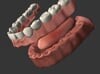 Immediate Dentures