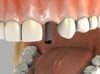 Single Tooth Implant