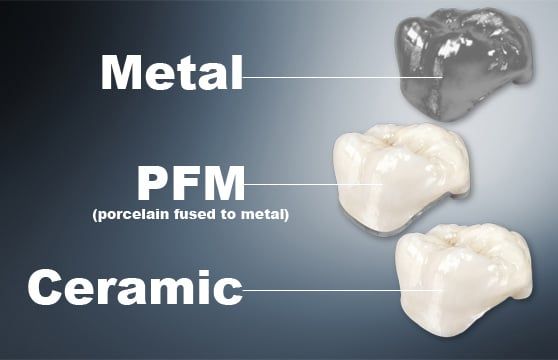 Types of Crowns