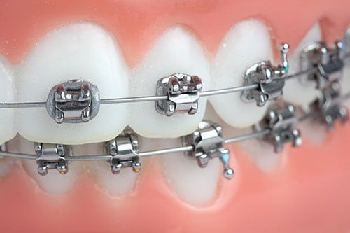 Conventional Braces